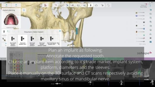 3Shape Implant Studio 2021:  New Detailed Workflow