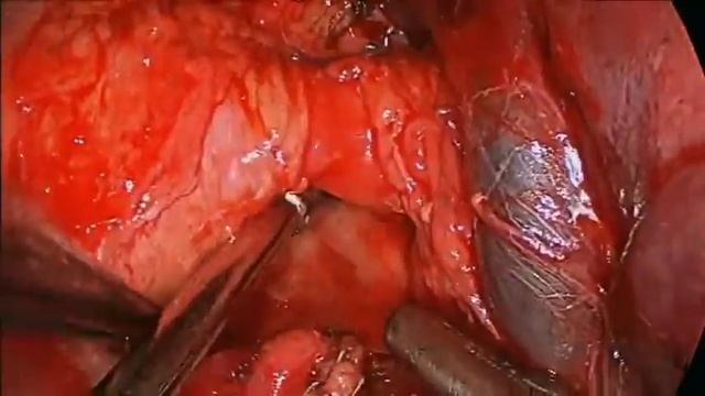 16 201GS Transcervical Extended Mediastinal Lymphadenectomy Assisted Thoracoscopic Left... смотреть онлайн