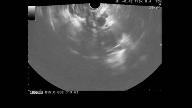 Пресакральные кисты смотреть онлайн