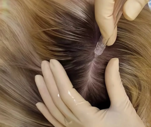 Газожидкостный пилинг головы