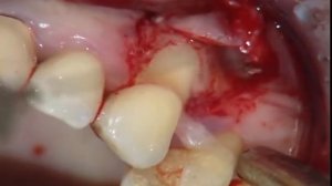 Пластика десны при оголении корня зуба