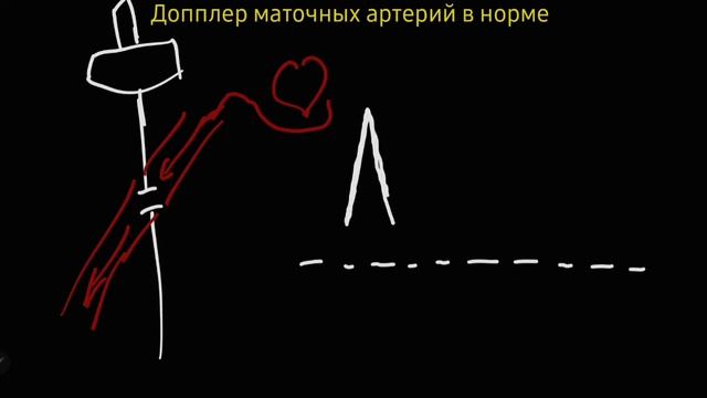 Допплер маточных артерий. Простая концепция смотреть онлайн