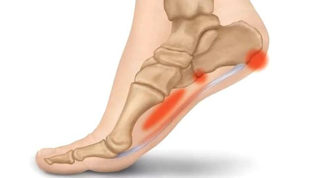 Пяточная шпора. Причины, симптомы, лечение. смотреть онлайн