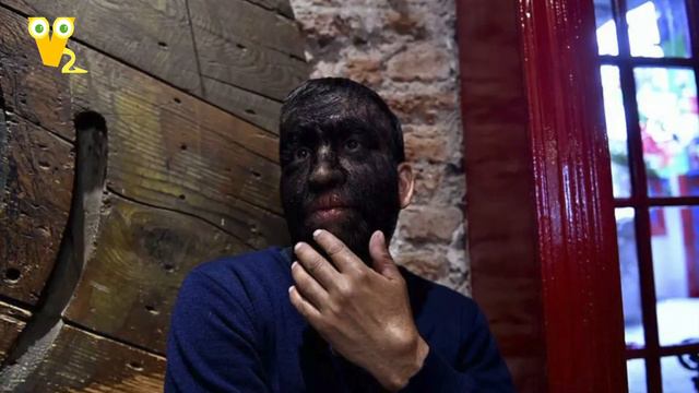 These Parents Were Left Distraught When Their Children All Developed Werewolf Syndrome смотреть онлайн