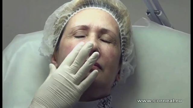 Контурная пластика - мезонити не противопоказание...но...