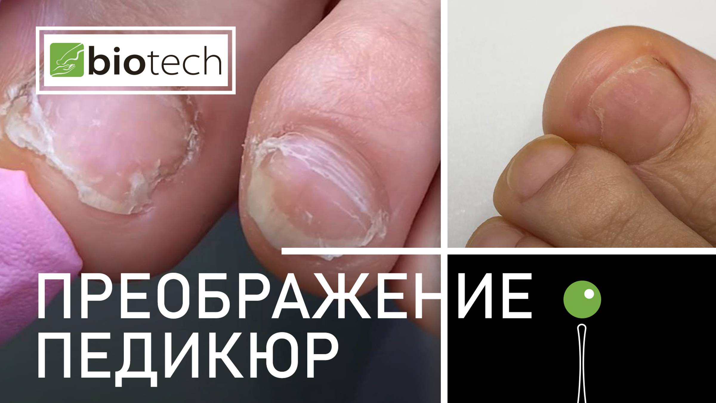 АППАРАТНЫЙ ПЕДИКЮР. ПРЕОБРАЖЕНИЕ.