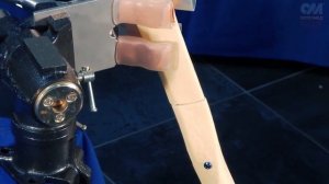 Хирургическая техника PTN Блокируемый штифт для остеосинтеза большеберцовой кости