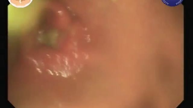 17 Рак антрального відділу шлунка смотреть онлайн