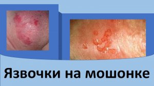 Язвочки на мошонке