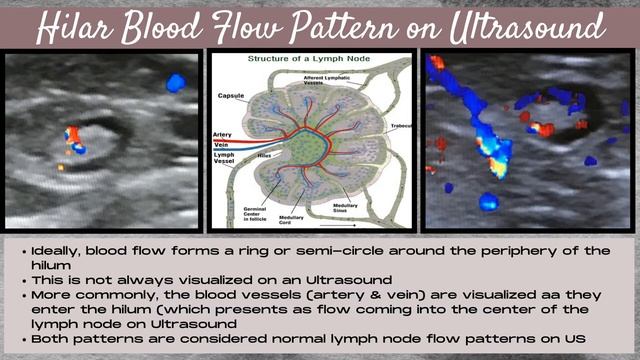 Breast Ultrasound - Features of a Normal Lymph Node - Sonography Minutes смотреть онлайн