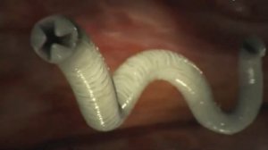 Онихофагия: Что будет если грызть ногти?