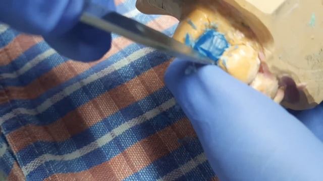 Моделировка промежуточной части мостовидного протеза под фасетку. смотреть онлайн