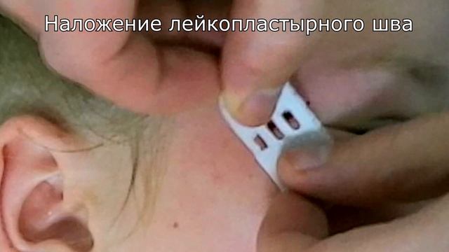 Пластырь для стягивания ран смотреть онлайн