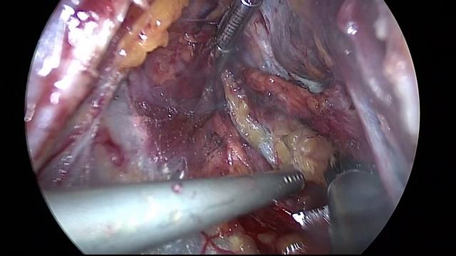 Laparoscopic Pelvic Lymph node dissection , Using ICG смотреть онлайн