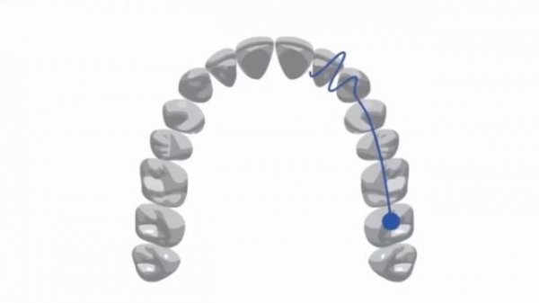 Внутриротовое 3D сканирование 3shape Trios 3 процесс | Sergatiy Dental Clinic