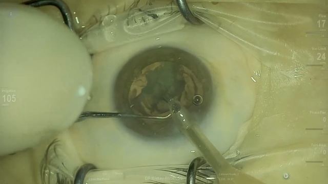Posterior polar cataract and Luxsmart EDOF Vista Live Stream смотреть онлайн
