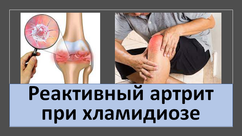 Реактивный артрит при хламидиозе смотреть онлайн