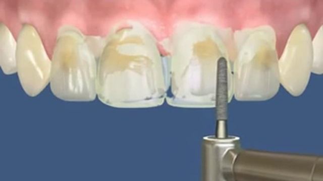 Люминиры. Установка люминиров в Казани смотреть онлайн