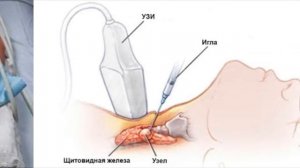 Узлы щитовидной железы. Какие оперировать? Что делать? операция узлов щитовидной железы