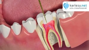 Пульпит. Лечение каналов зуба.