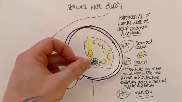 Sentinel Node Biopsy for Melanoma смотреть онлайн