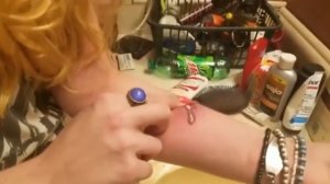 МНОГО ГНОЯ! Выдавливание прыщей