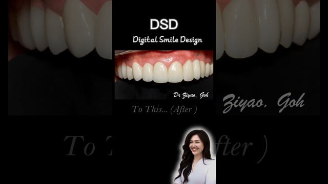 Smile makeover achieved with crowns and bridges after oral hygiene management 👄💯 смотреть онлайн