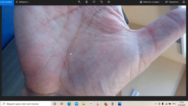 Как выглядит онкология на руках смотреть онлайн