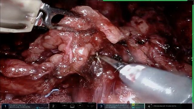 Robotic Retro-Peritoneal Lymph Node Dissection (RPLND) by Dr Sandeep Nayak смотреть онлайн