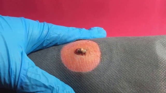 BEST Pimple Popping / Whiteheads Removal / Big Cystic Acne Blackheads / Squeezing Pimples / Tr#0003 смотреть онлайн