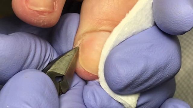 Педикюр. По ногтем мозоль. Удаление мозоли. Онихолизис. смотреть онлайн