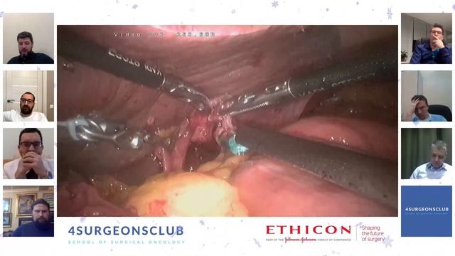 Лапароскопическая проксимальная гастрэктомия