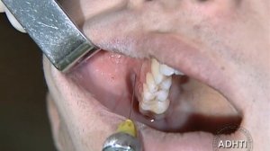 инфильтрационная анестезия первого моляров...infiltration anesthesia of the first molar