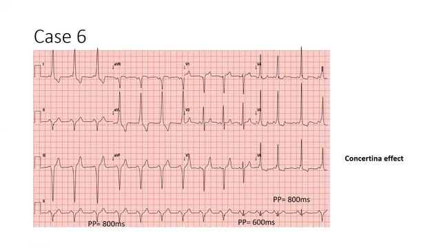 Interactive ECG Session - Dr Mukund A Prabhu | Prof Dr K U Natarajan | Dr Maneesh Rai смотреть онлайн