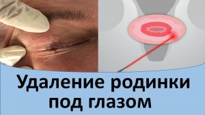 Удаление родинки под глазом.