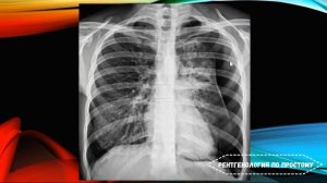 Рентген легких ( Расшифровка ), методика описания, дифференциальная диагностика.