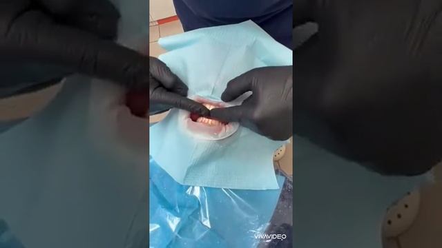 коронки из диоксида циркония, без металла ,تركيبات زيركون التجميليه смотреть онлайн