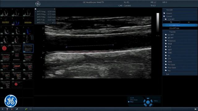 Исследование сонных артерий смотреть онлайн