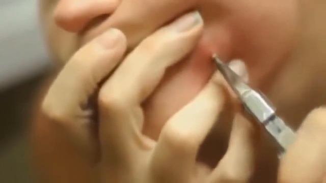 УДАЛЕНИЕ ФУРУНКУЛА НА ЛИЦЕ ДЕВУШКИ ПЛОСКОГУБЦАМИ!!!!! смотреть онлайн