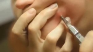 УДАЛЕНИЕ ФУРУНКУЛА НА ЛИЦЕ ДЕВУШКИ ПЛОСКОГУБЦАМИ!!!!!