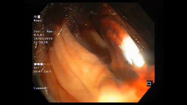 Эндоскопическое клипирование смотреть онлайн