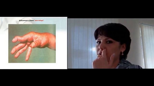 Арапу Марина Ивановна - "О лечении больных с ревматоидным артритом" 29 07 2015 смотреть онлайн