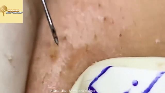 Выдавливание прыщей, залипательно№1 смотреть онлайн