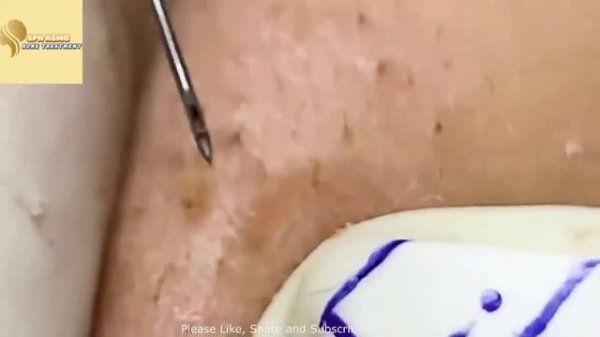 Выдавливание прыщей, залипательно№1