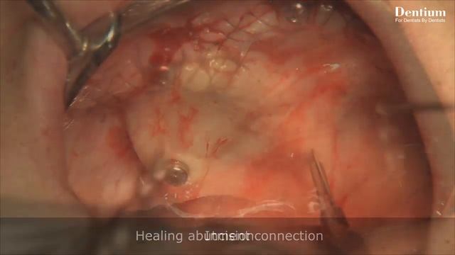 Overdenture with mini ball attachment_4 minute short version смотреть онлайн