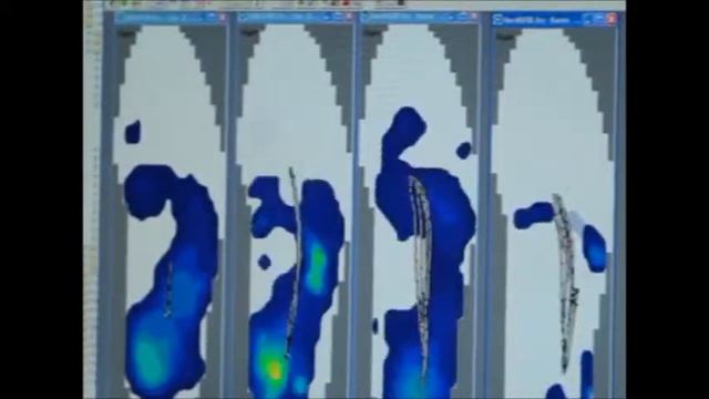 Reno Good Feet arch supports Bill Walton Mary Lou Retton live pain free GET orthotics смотреть онлайн