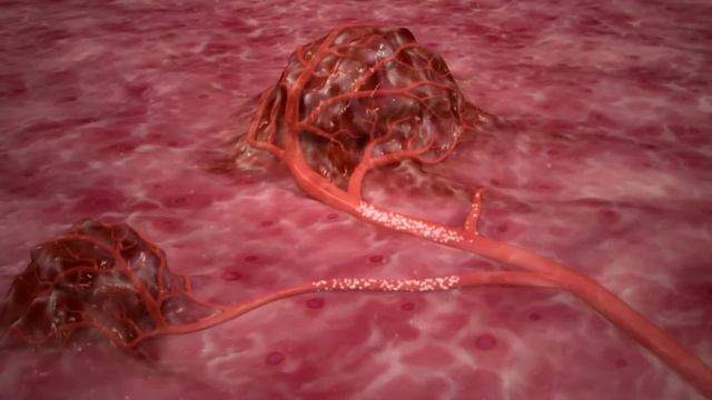 Selective Internal Radiation Therapy (SIRT) | Capital Health Hospital смотреть онлайн