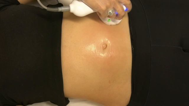 TempSure Firm неинвазивный лифтинг смотреть онлайн