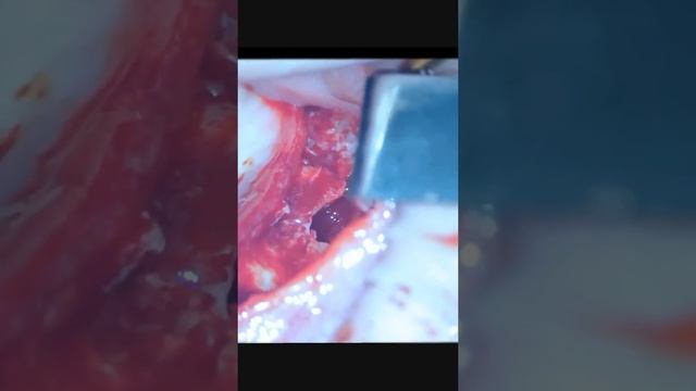 Открытый синус лифтинг , закрытый синус , гайморова пазуха , увеличение кости имплантация зуба смотреть онлайн