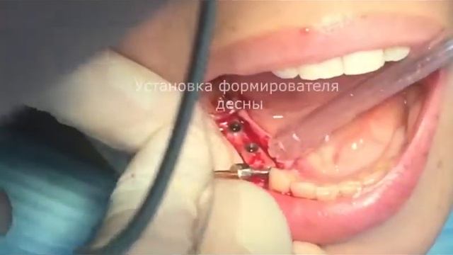 Установка формирователя десны. смотреть онлайн